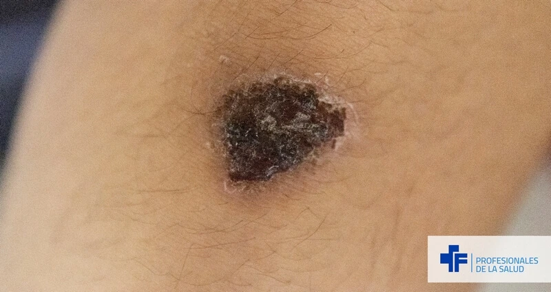 Primer plano de una costra, una lesión elemental secundaria asociada a diversas patologías dermatológicas.