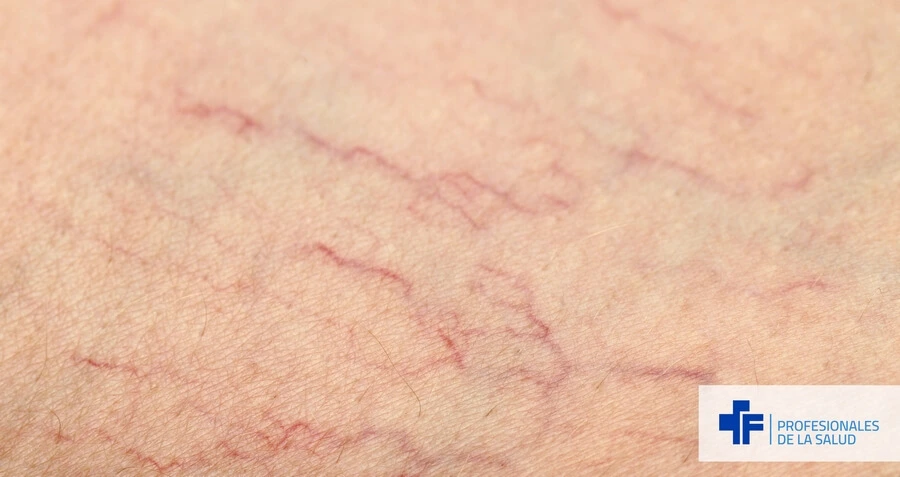 Primer plano de telangiectasias o arañas vasculares, una de las muchas lesiones elementales primarias que se ven en dermatología.