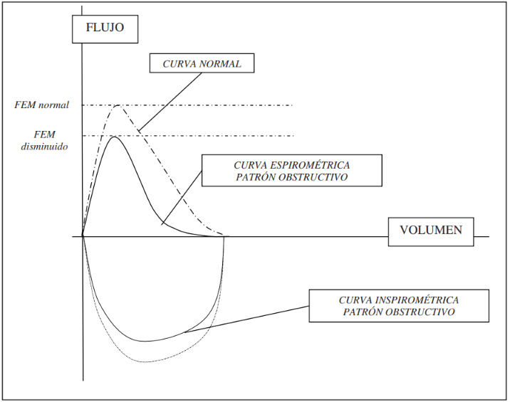Curva flujo-volumen típica del patrón obstructivo en una espirometría.