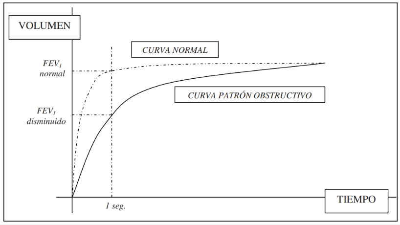 Curva volumen-tiempo característica del patrón obstructivo espirométrico.